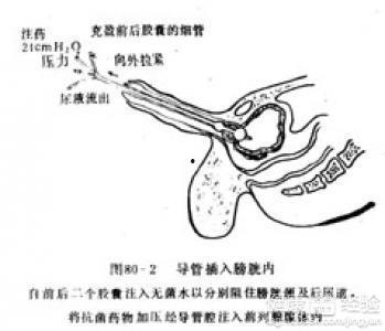 慢性前列腺炎按摩视频,专业视频教程详解